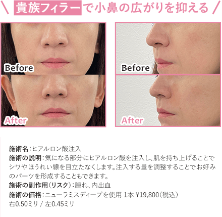 ほうれい線の改善