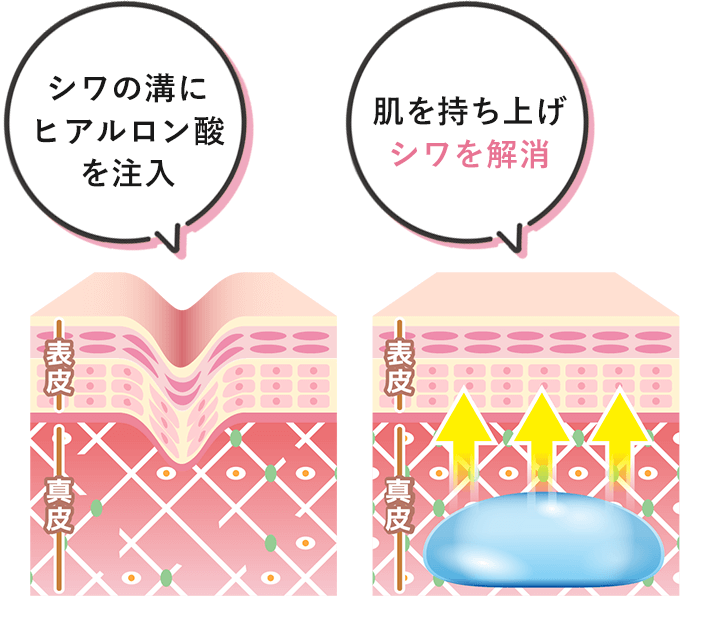 シワの溝にヒアルロン酸を注入 肌を持ち上げシワを解消