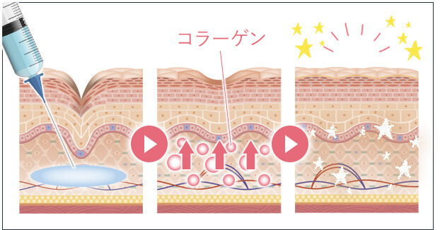 ジュベルックとは?