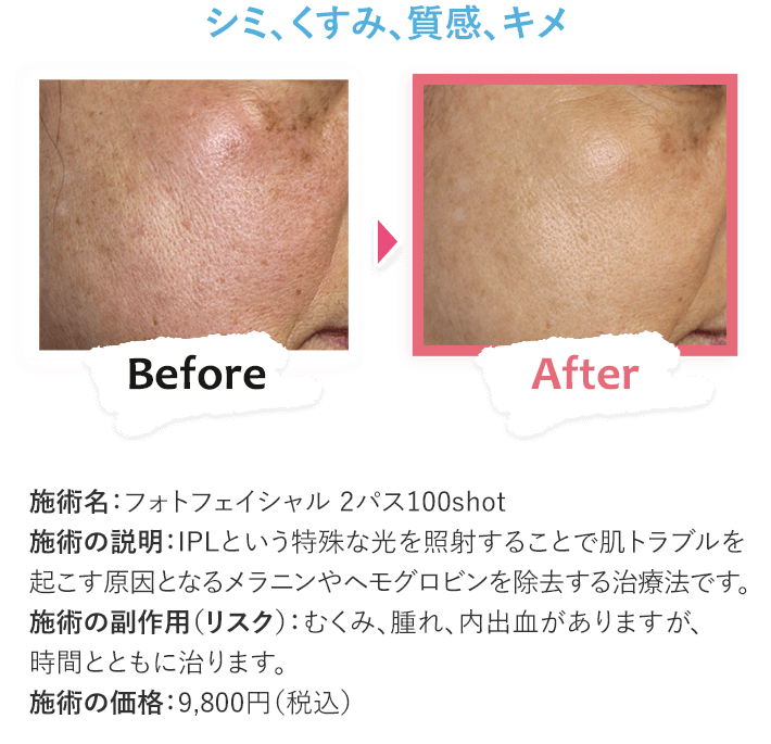 シミ、くすみ、質感、キメ