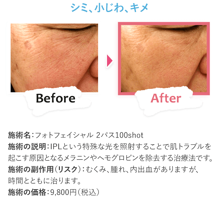 シミ、小じわ、キメ