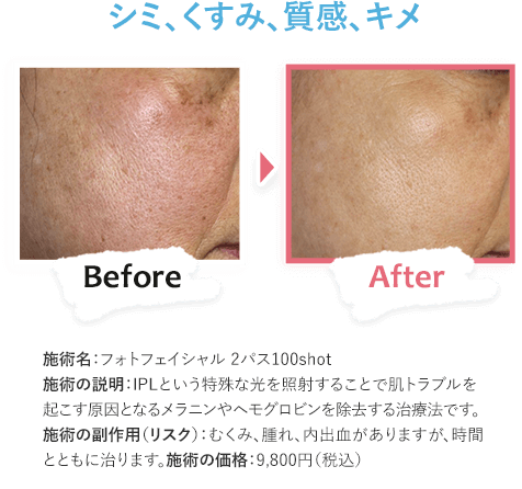 シミ、くすみ、質感、キメ