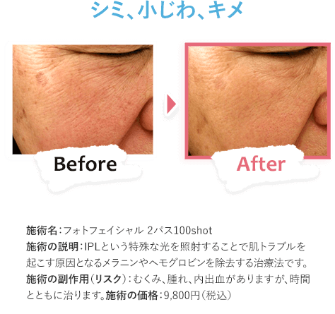 シミ、小じわ、キメ